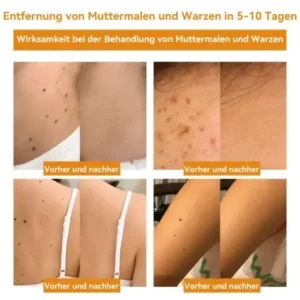 Vsoxa™ Bienengift Waren & Muttermalenfernung Creme