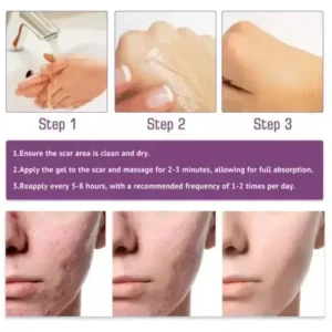 Zoencgz™ Advanced Scar Gel